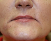 Feel Beautiful - Filler in frown lines San Diego - Before Photo